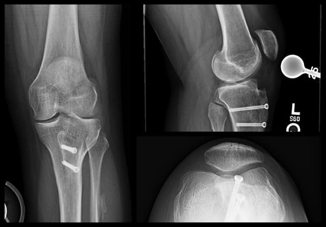 Patellofemoral Arthroplasty pre-op 1