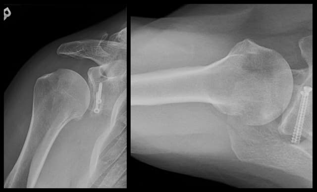 Glenoid Reconstruction with Allograft post-op 1