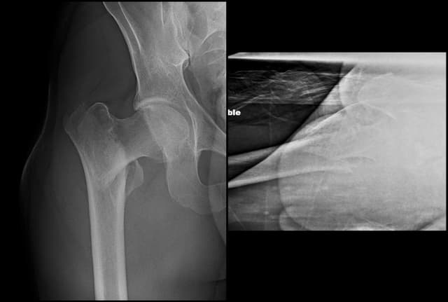 Intertrochanteric Fracture Short Nail pre-op 1