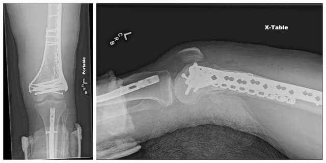 Distal Femur ORIF post-op 1