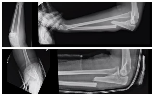 Monteggia Fracture ORIF pre-op 1