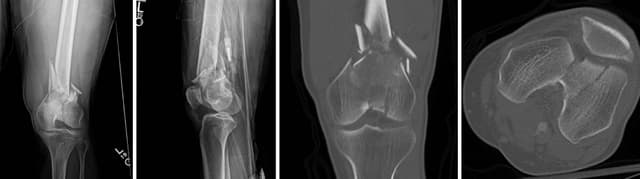 Distal Femur ORIF pre-op 1