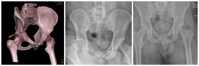 Posterior Wall Acetabulum ORIF pre-op 1