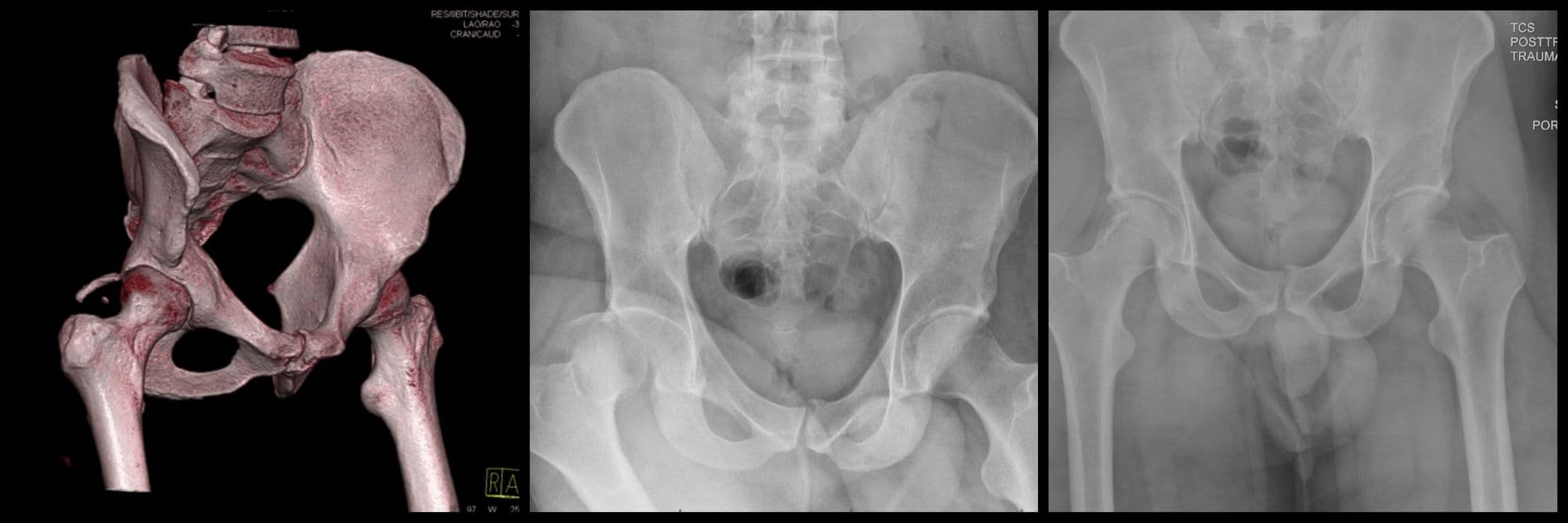 Posterior Wall Acetabulum ORIF