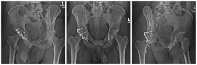Posterior Wall Acetabulum ORIF post-op 1