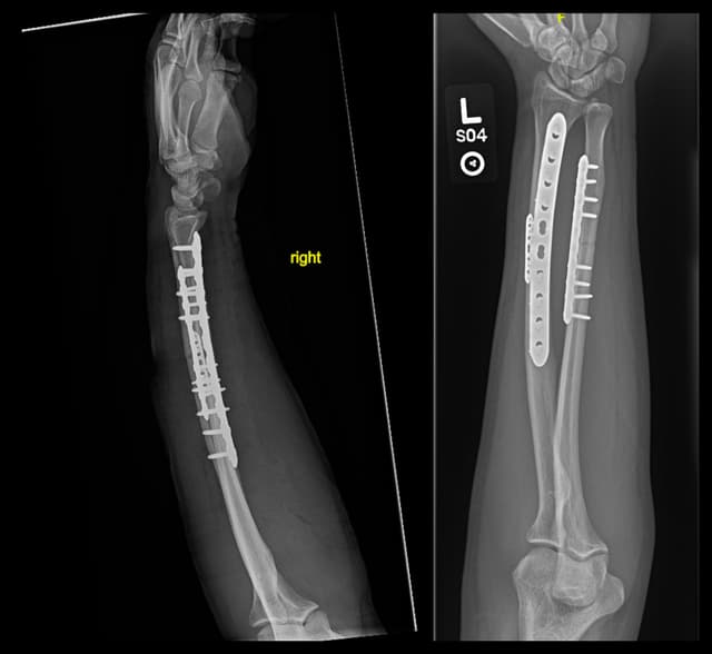 Radius/ulna shaft (both bone forearm) ORIF post-op 1