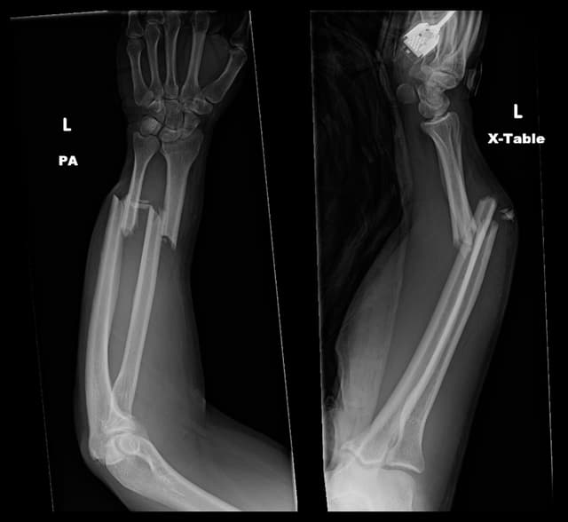 Radius/ulna shaft (both bone forearm) ORIF pre-op 1