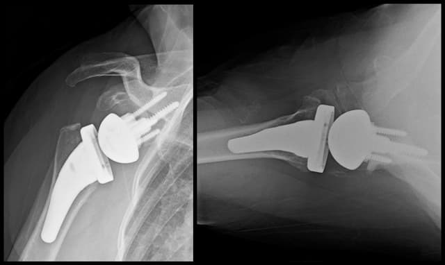 Reverse Shoulder Arthroplasty (patient-specific guide) post-op 1