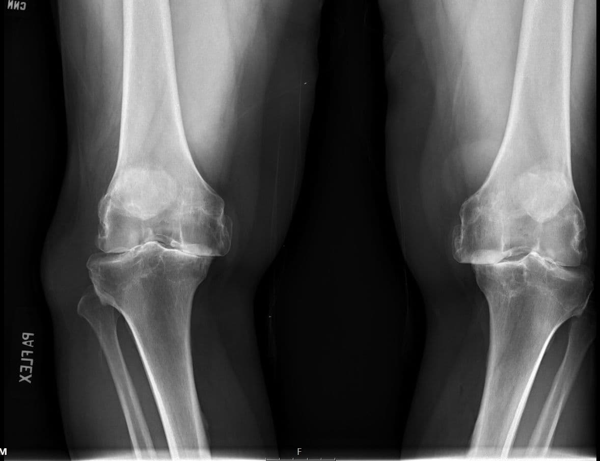 Total Knee Arthroplasty (Cementless, Robotic-assisted)