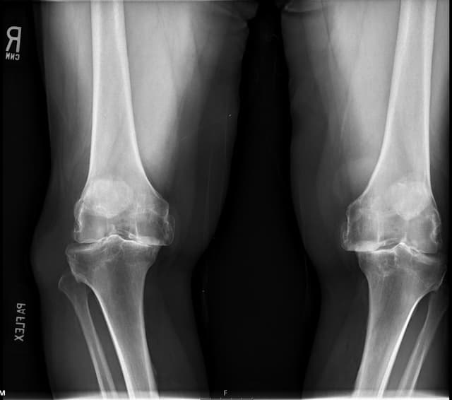 Total Knee Arthroplasty (Cementless, Robotic-assisted) pre-op 1