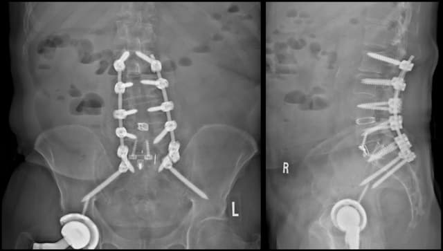 L5-S1 Anterior lumbar interbody fusion post-op 1