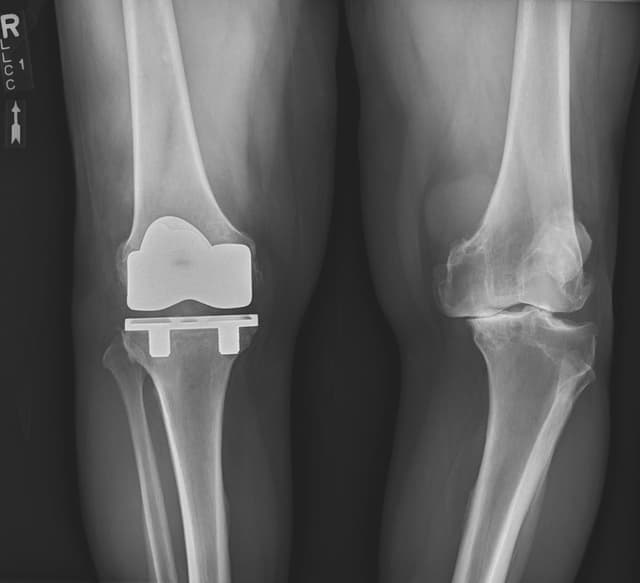 Total Knee Arthroplasty (Cementless, Robotic-assisted) post-op 1