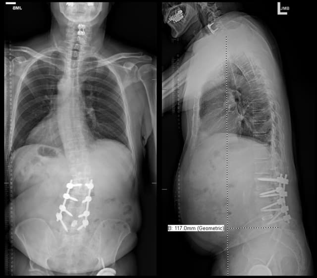 L5-S1 Anterior lumbar interbody fusion pre-op 1