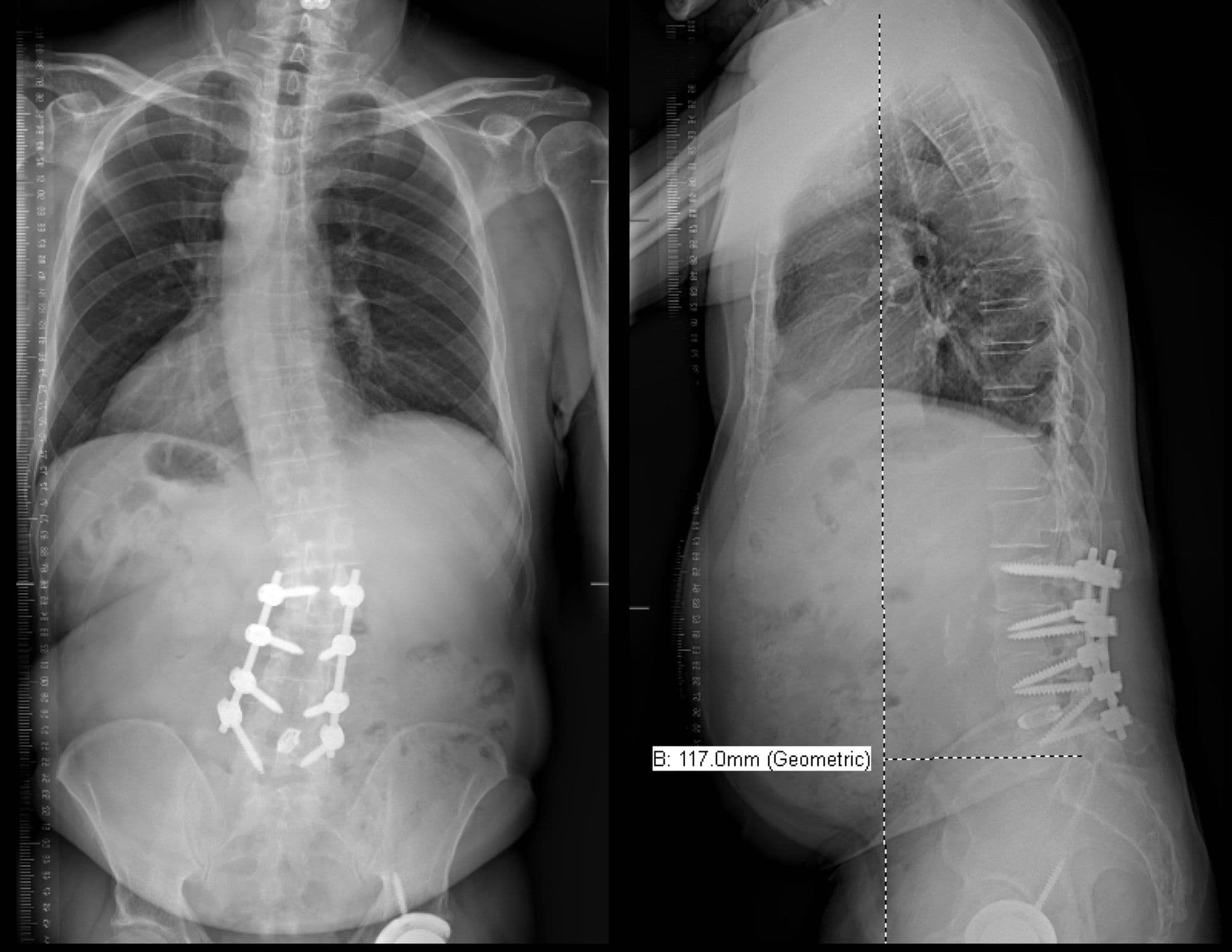 L5-S1 Anterior lumbar interbody fusion