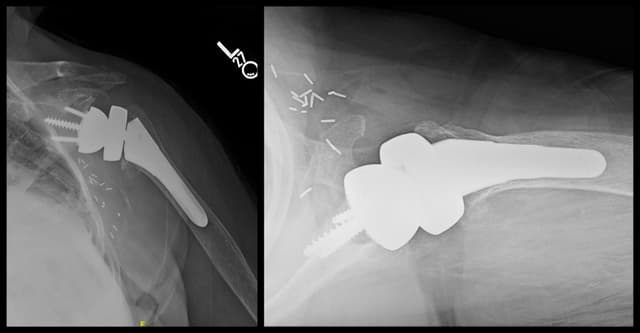 Reverse Shoulder Arthroplasty post-op 1
