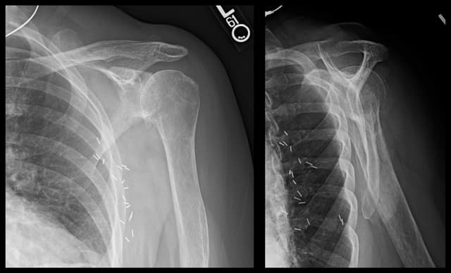Reverse Shoulder Arthroplasty pre-op 1