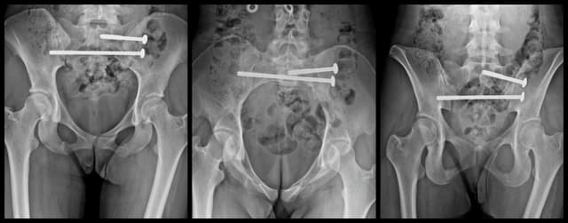 Posterior Sacroiliac Joint Fixation post-op 1