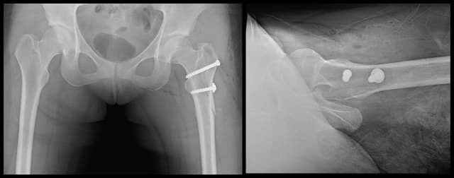 Surgical Hip Dislocation post-op 1