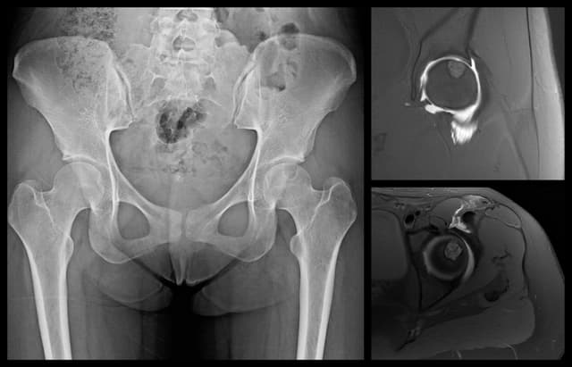 Surgical Hip Dislocation pre-op 1