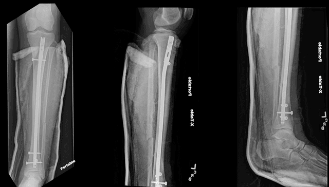 Distal Tibia IMN post-op 1