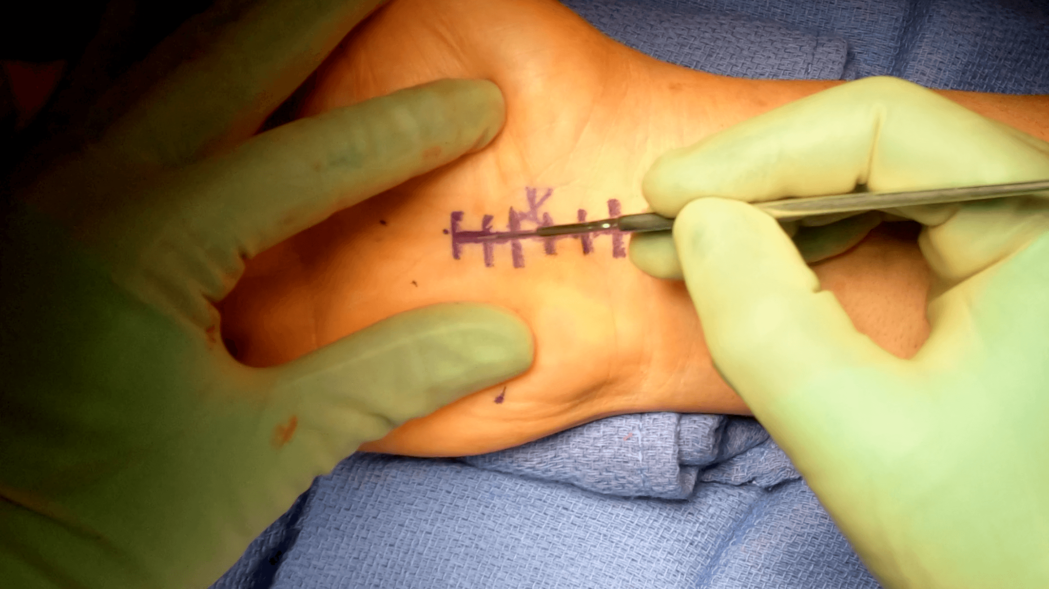 Carpal Tunnel Release