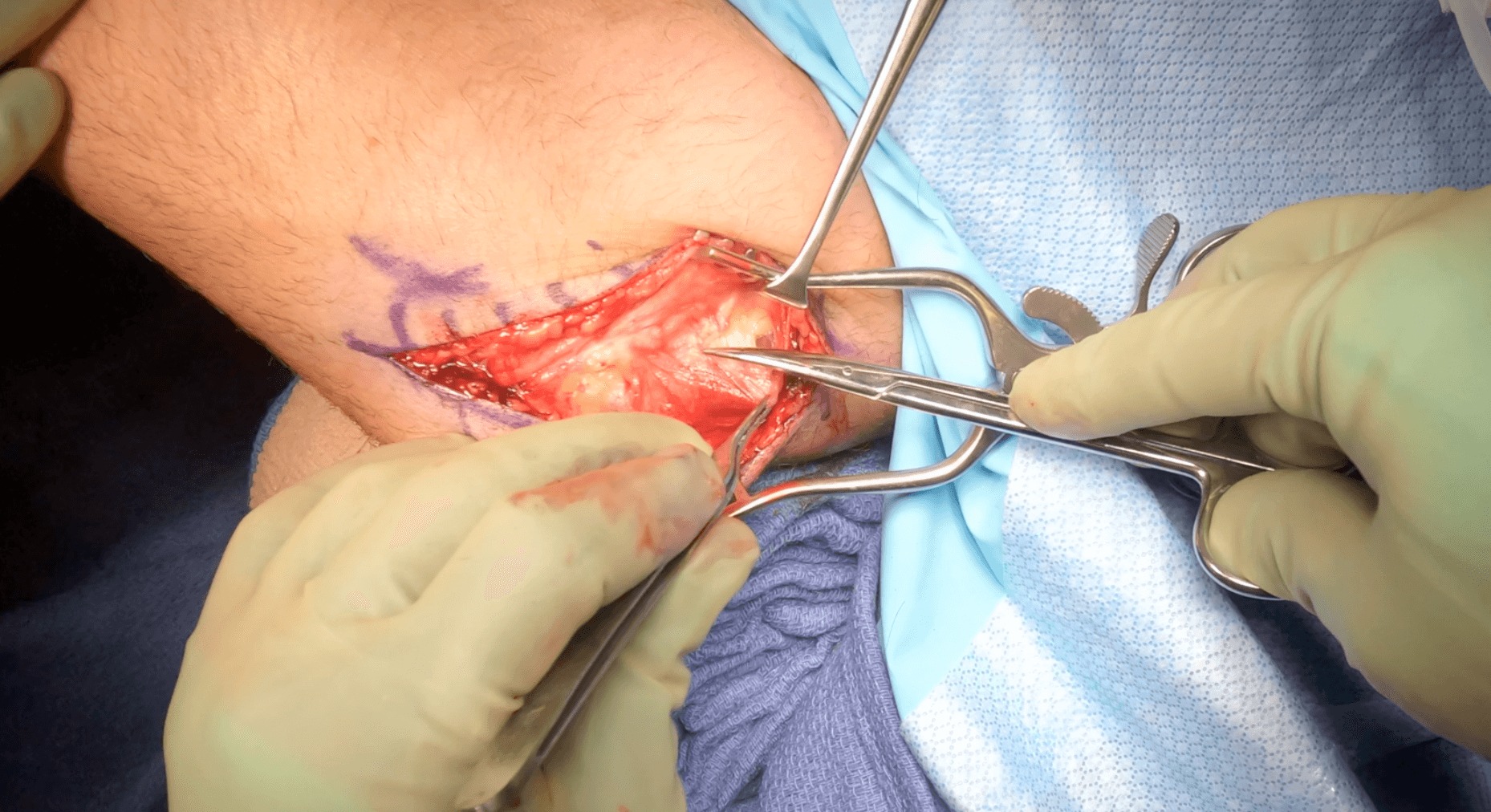 Cubital Tunnel Release