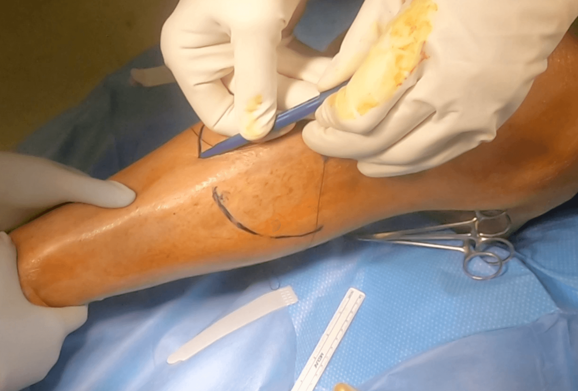 Below Knee Amputation