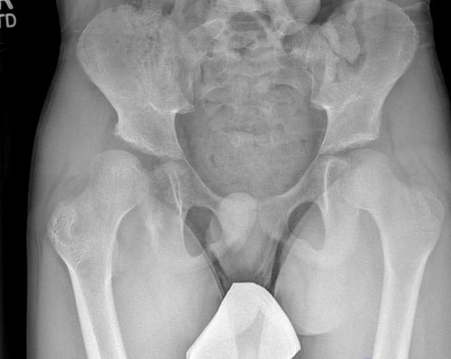 Varus Derotational Osteotomy of Proximal Femur pre-op 1