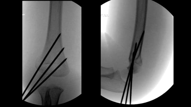 Supracondylar humerus CRPP post-op 1