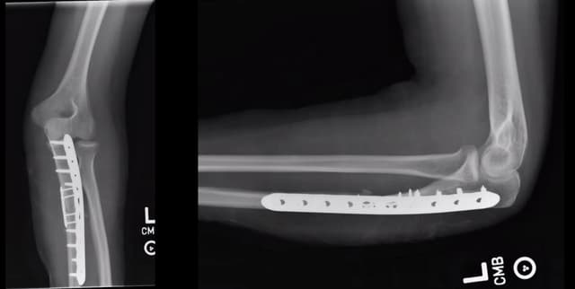 Monteggia Fracture ORIF post-op 1