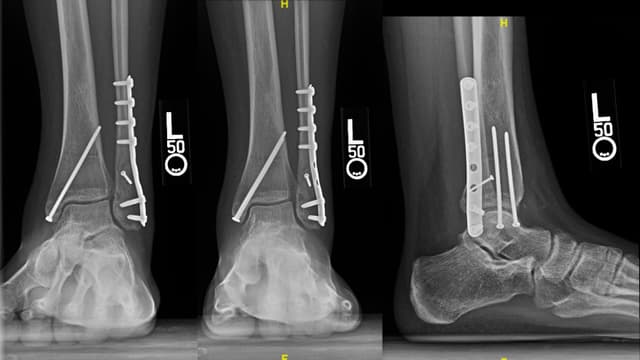 Ankle ORIF post-op 1