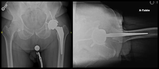 Total Hip Arthroplasty (Posterior) post-op 1