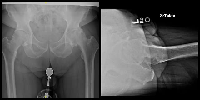 Total Hip Arthroplasty (Posterior) pre-op 1