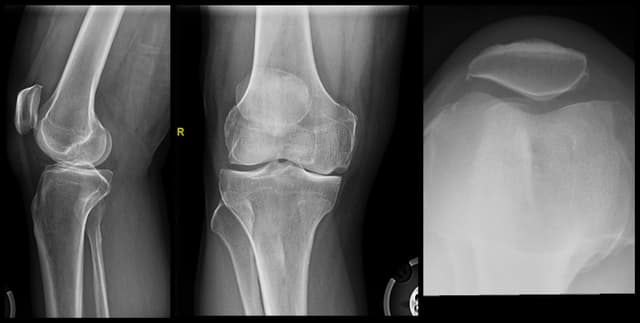 Unicompartmental Knee Arthroplasty pre-op 1