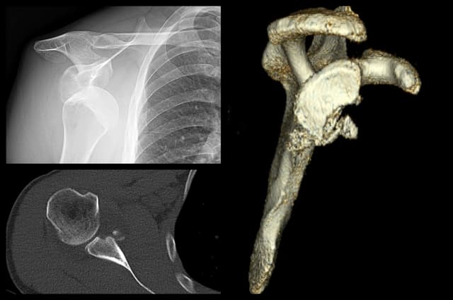 Glenoid Reconstruction with Allograft pre-op 1