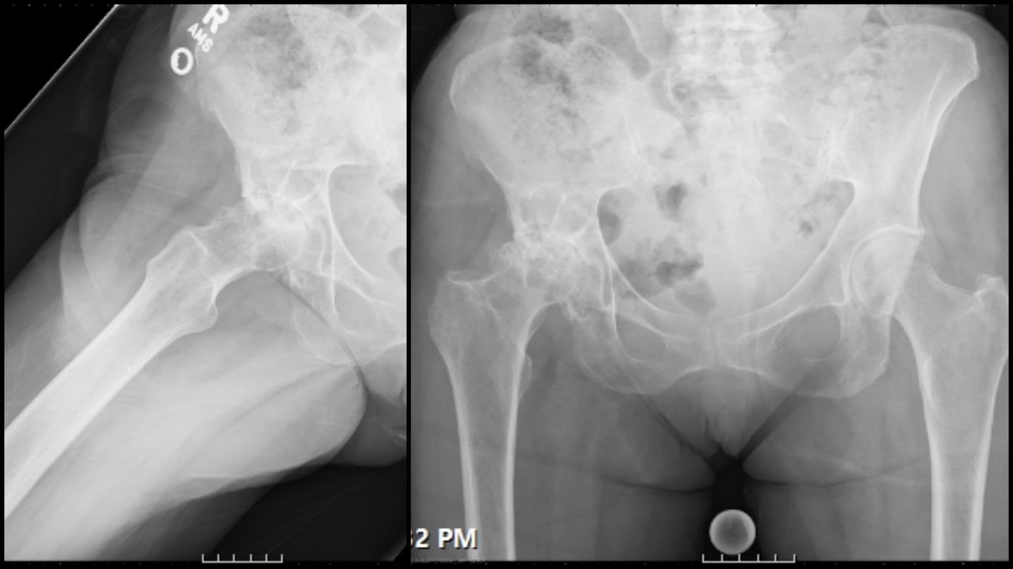 Total Hip Arthroplasty (Anterior)