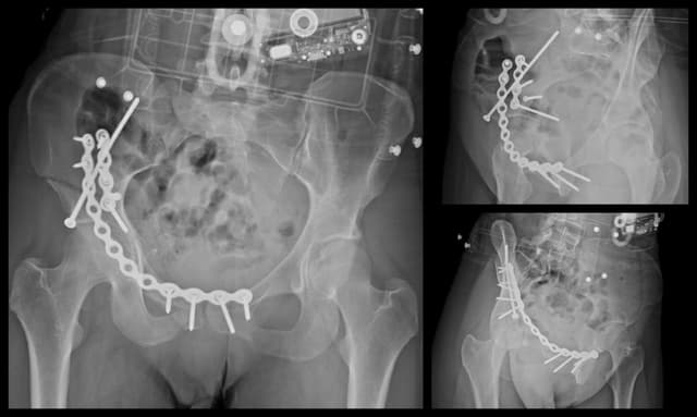 Anterior Column Acetabulum ORIF post-op 1