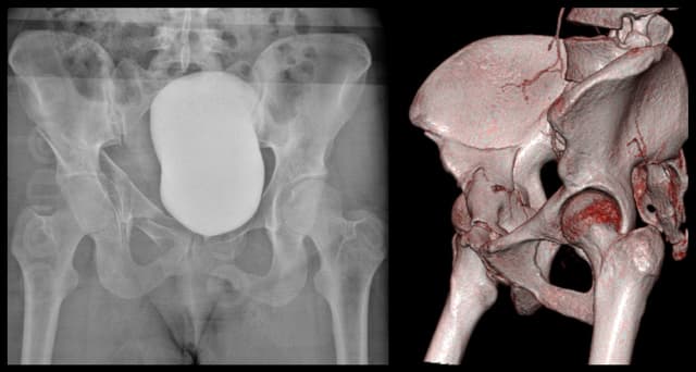 Anterior Column Acetabulum ORIF pre-op 1