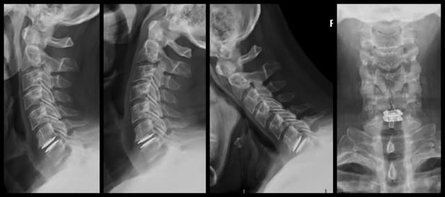 Cervical Disc Replacement post-op 1