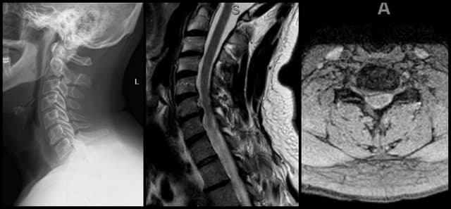 Cervical Disc Replacement pre-op 1