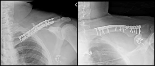 Clavicle ORIF post-op 1