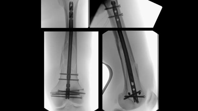 Distal Femur ORIF and IMN post-op 1