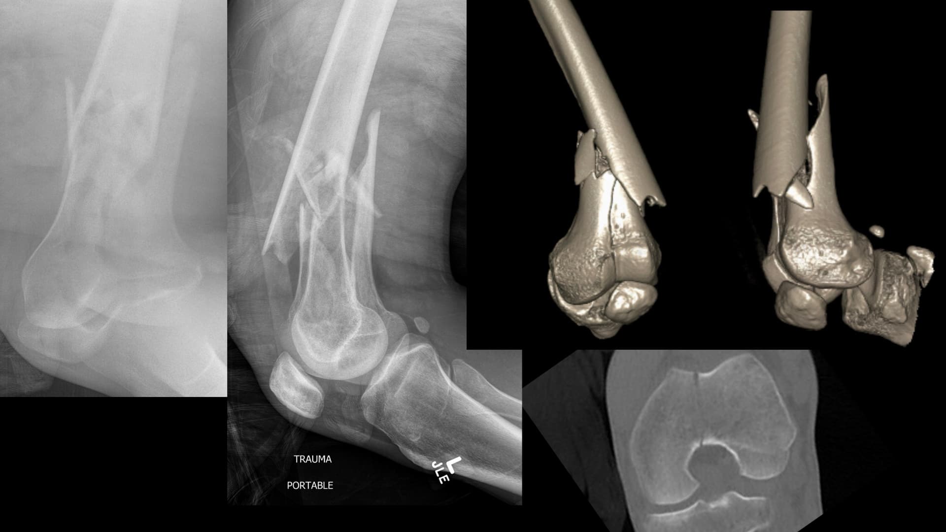 Distal Femur ORIF and IMN