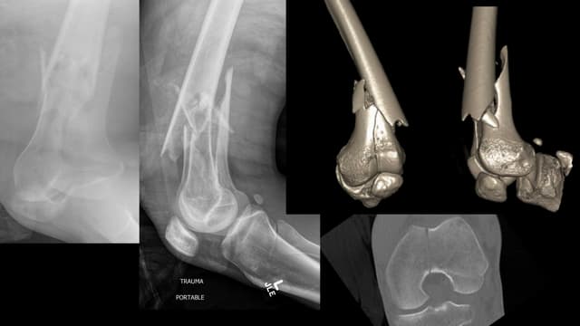 Distal Femur ORIF and IMN pre-op 1