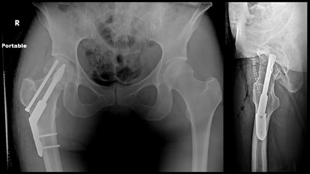 Femoral Neck ORIF post-op 1
