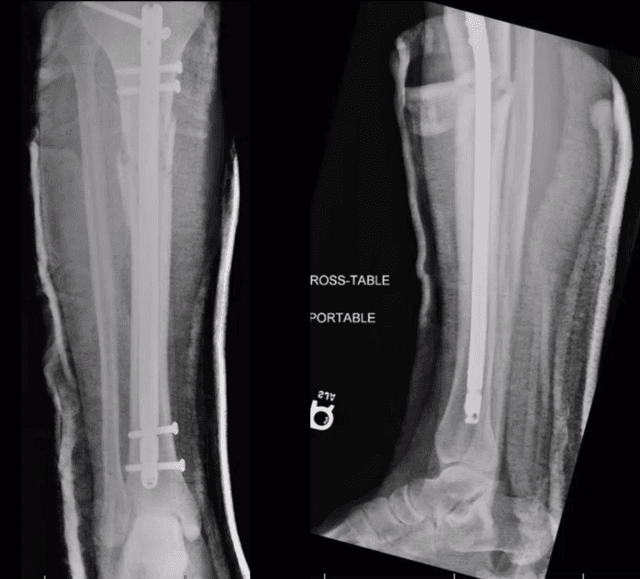 Proximal Tibia IMN post-op 1