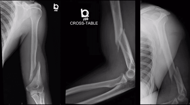 Distal Humerus ORIF pre-op 1