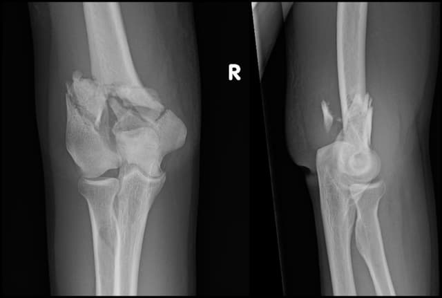 Intra-articular Distal Humerus ORIF pre-op 1
