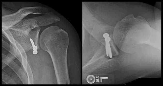Latarjet Procedure post-op 1
