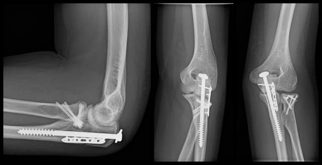 Olecranon and Radial Head ORIF post-op 1